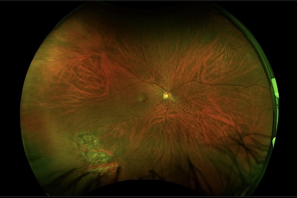 Optomap saving sight img1